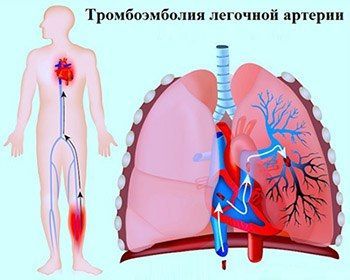 Тромбоэмболия лёгочной артерии