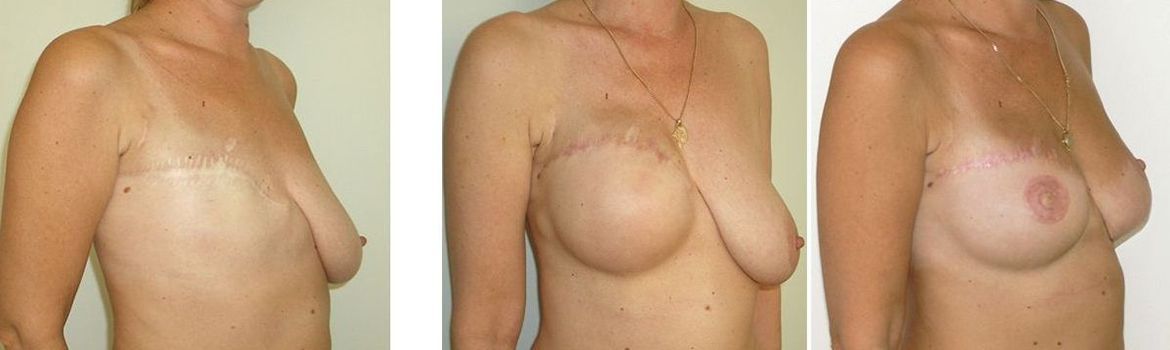 Удаление имплантов груди (молочных желёз)