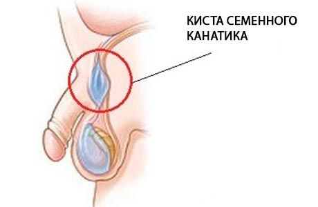 Удаление кисты семенного канатика