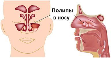 Удаление полипов в носу