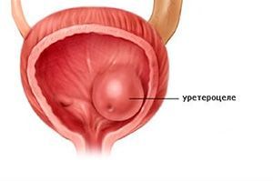 Устье Мочеточника У Мужчин Где Находится Фото