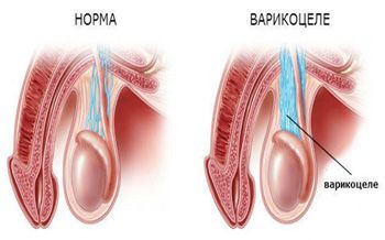 Операция при варикоцеле