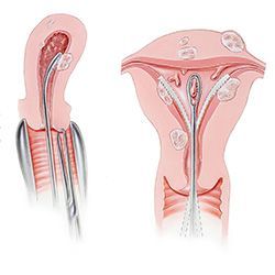 Выскабливание полости матки - Диагностическое и раздельное - Международный центр охраны здоровья