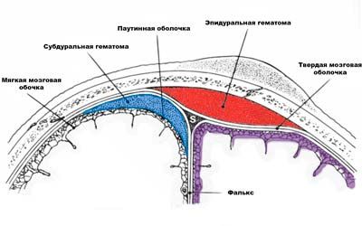 Внутричерепные гематомы