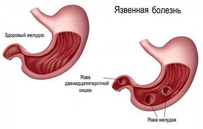 Язвенная болезнь