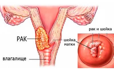 Лечение и диагностика заболеваний шейки матки