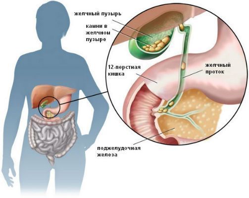 что такое желчекаменная болезнь