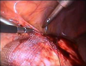 Лапароскопическая нефропексия (I категория сложности) в клинике ЦЭЛТ в Москве