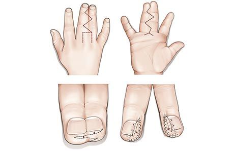 Операция при синдактилии в клинике ЦЭЛТ в Москве