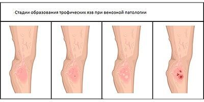 Венозные трофические язвы