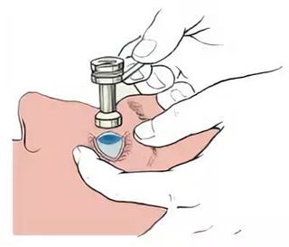 Офтальмотонометрия в клинике ЦЭЛТ в Москве