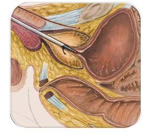 Трансуретральная резекция опухоли (папилломы) мочевого пузыря (I категория сложности) в клинике ЦЭЛТ в Москве