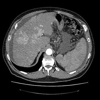 КТ селезёнки в клинике ЦЭЛТ в Москве