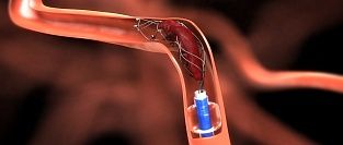 Эндоваскулярная тромбэктомия аспирационная в клинике ЦЭЛТ в Москве