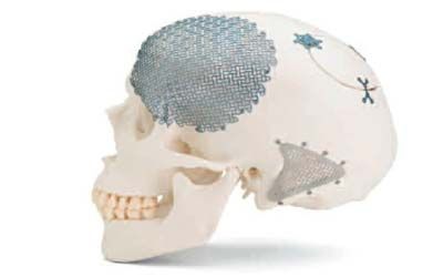 Пластика дефектов костей черепа