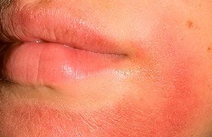 Контактный аллергический дерматит