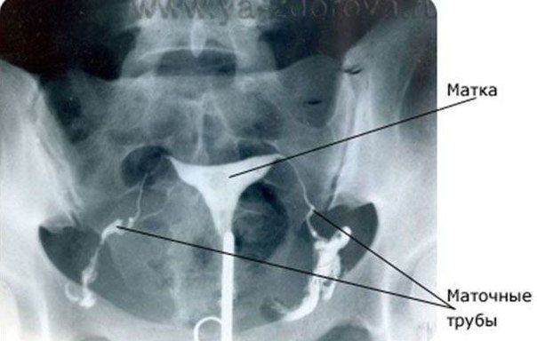 Гистеросальпингография. Исследование в клинике ЦЭЛТ в Москве