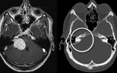 Опухоли невринома