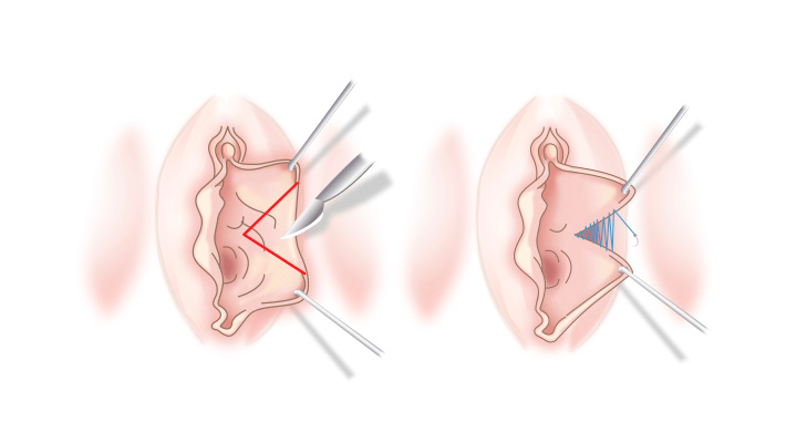 Пластика малых и больших половых губ  в клинике ЦЭЛТ в Москве