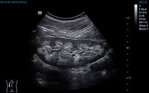 Ультразвуковое исследование почек и надпочечников в клинике ЦЭЛТ в Москве