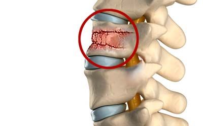 Переломы позвонков
