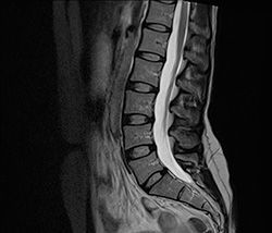 Магнитно-резонансная томография позвоночника (шейный, грудной, поясничный, крестцовый) один отдел в клинике ЦЭЛТ в Москве