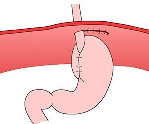 Грыжа пищеводного отверстия диафрагмы