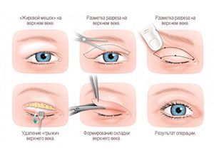 Верхняя блефаропластика I категория сложности в клинике ЦЭЛТ в Москве