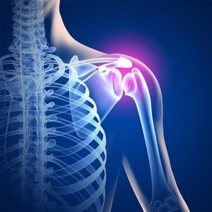 Деформирующий остеоартроз плечевого сустава