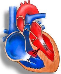 Эндоваскулярное лечение порока сердца в клинике ЦЭЛТ в Москве