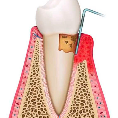 Закрытый кюретаж при заболеваниях пародонта в области зуба (1 зуб) в клинике ЦЭЛТ в Москве