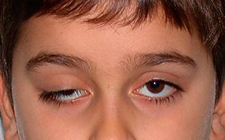 Опущение века (птоз)