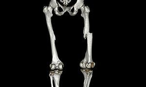 КТ трубчатых костей в клинике ЦЭЛТ в Москве