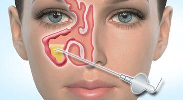 Пункция околоносовых пазух в клинике ЦЭЛТ в Москве