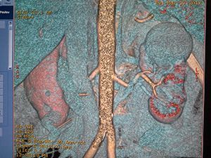 Компьютерная томография почек и надпочечников в клинике ЦЭЛТ в Москве