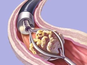 Цистолитотрипсия-контактная (I категория сложности) в клинике ЦЭЛТ в Москве