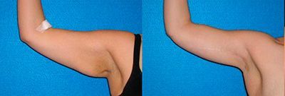 Брахиопластика I категория сложности в клинике ЦЭЛТ в Москве