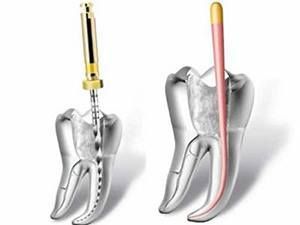 Временное пломбирование лекарственным препаратом корневого канала в клинике ЦЭЛТ в Москве