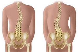 Сколиоз позвоночника 4 степени
