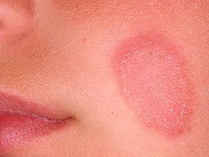 Розовый лишай