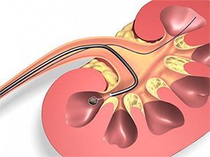 Использование набора для лазерной ретроградной уретеролитотрипсии в клинике ЦЭЛТ в Москве
