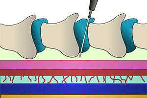 Эпидуральная аналгезия (каудальная лечебно-медикаментозная блокада) в клинике ЦЭЛТ в Москве