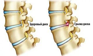 Удаление грыжи межпозвоночного диска в клинике ЦЭЛТ в Москве
