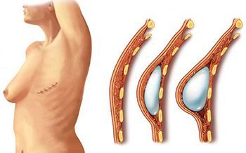 Эндопротезирование молочных желез с мастопексией