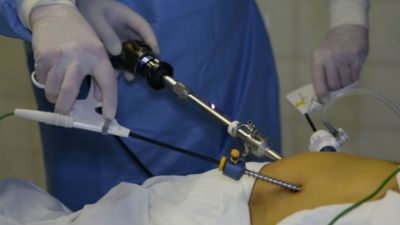 Эндоскопическая холецистэктомия (I категория сложности) в клинике ЦЭЛТ в Москве