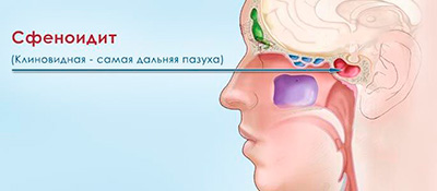 Сфеноидотомия (I категория сложности) в клинике ЦЭЛТ в Москве