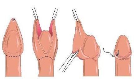 Циркумцизия (I категория сложности) в клинике ЦЭЛТ в Москве