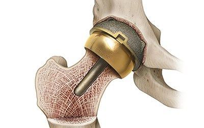 Эндопротезирование тазобедренного сустава нестандартное, сложное (без стоимости эндопротеза) (I категории сложности) в клинике ЦЭЛТ в Москве