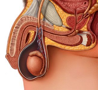 Операция при водянке оболочек яичка (I категория сложности) в клинике ЦЭЛТ в Москве