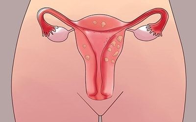 Дисфункциональные маточные кровотечения